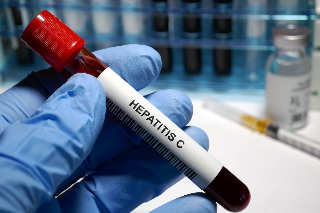 Signs and Symptoms of Hepatitis C image